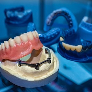 Model of implant dentures
