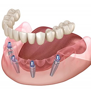Illustration of removable implant dentures