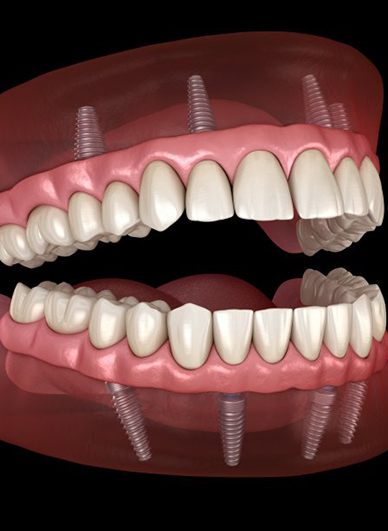 Illustration of implant dentures