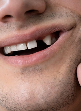 Man showing missing tooth