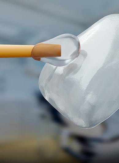 A closeup of a dental veneer with an applicator