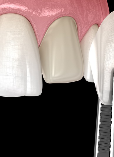 A 3D illustration of dental veneers being placed