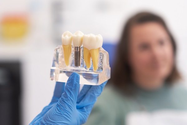 An Implant Dentist Discusses Bone Growth and Healing After Placement
